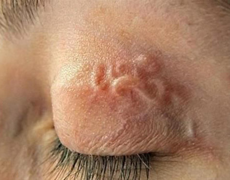 arcbőr kezelése parazitáktól a férgek megelőzésének módszerei