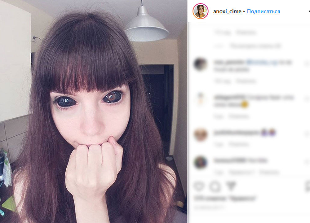 Тома ослепла. Люди с яëрными глазами. Тома ослепла. Люди с чёрными глазами без белков. Стеклянный глаз протез.